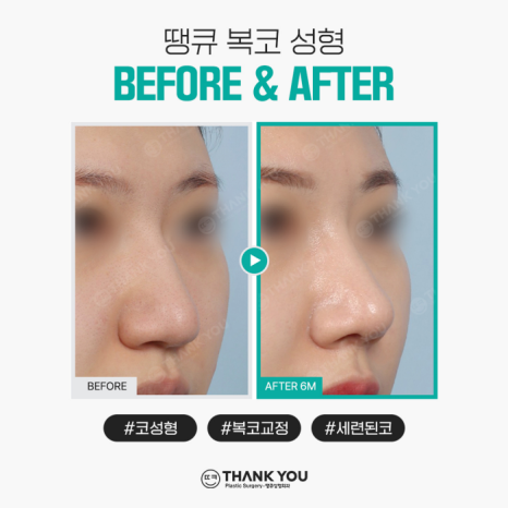 복코성형, 꼭 코뼈절골을 해야할까요? 관련 이미지 7