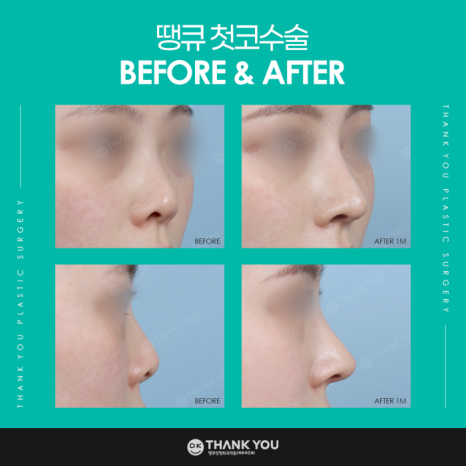첫코수술 성공을 위해 고려해야 할 점은? 관련 이미지 6