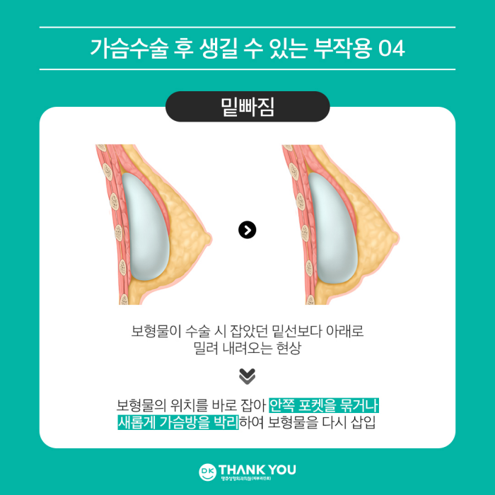 What Are the Side Effects of Breast Augmentation Surgery? image 6