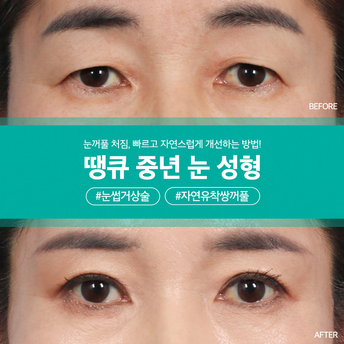 눈썹거상술 & 자연유착쌍꺼풀로 처진 눈꺼풀 효과적으로 개선! 관련 이미지 1