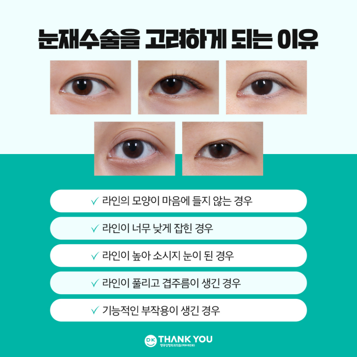 눈재수술전후 만족스러운 차이를 만들고 싶다면?! 관련 이미지 2