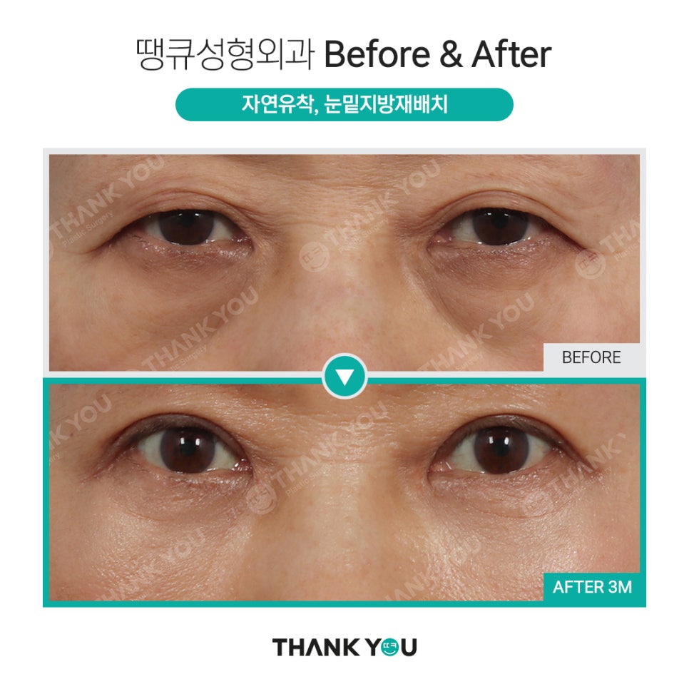 하안검과 눈밑지방재배치의 차이점? 관련 이미지 11