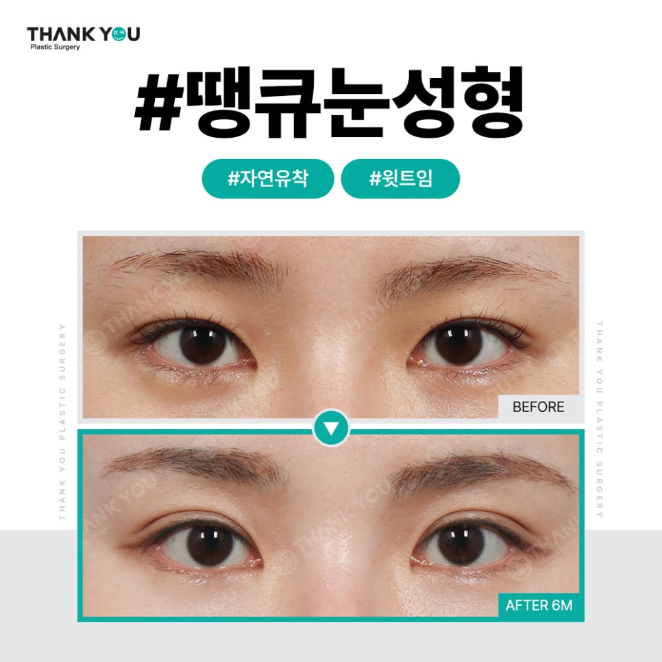 쌍꺼풀 라인 종류, 내게 맞는 쌍수랑 트임은?(인라인) 관련 이미지 7