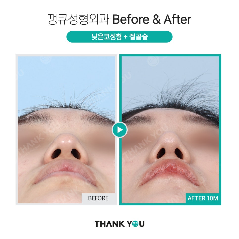 휜코 성형, 휜코 교정 과연 간단할까?(비포&애프터) 관련 이미지 8