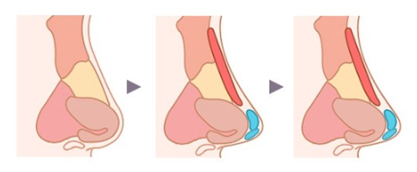 코성형 아직도 L자보형물? 실리콘 선택 기준은? 관련 이미지 1