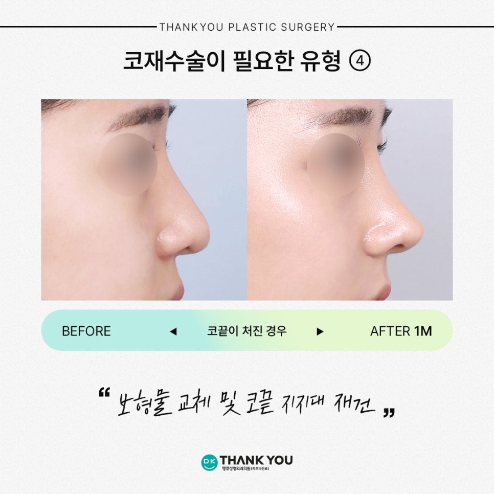 코재수술잘하는곳 땡큐가 제안하는 유형별 수술 방법은? 관련 이미지 6