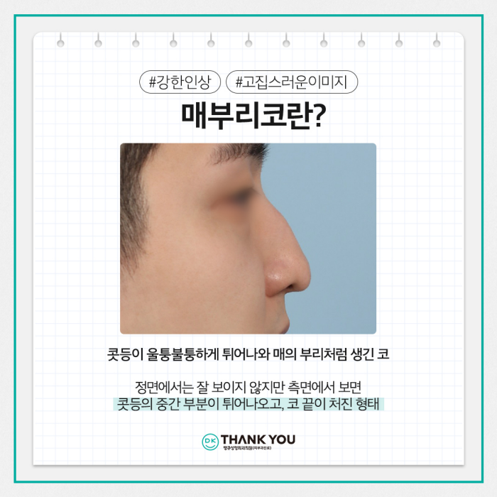 매부리코개선 맞춤 디자인으로 원하던 워너비 코 완성! 관련 이미지 2