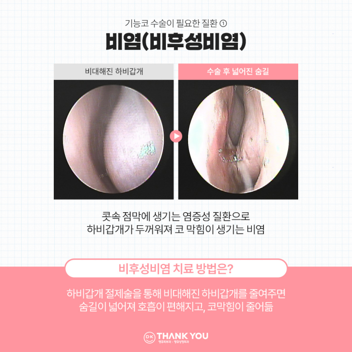 비염기능코수술과 미용코 성형을 동시에! 기능코성형 효과는?! 관련 이미지 3