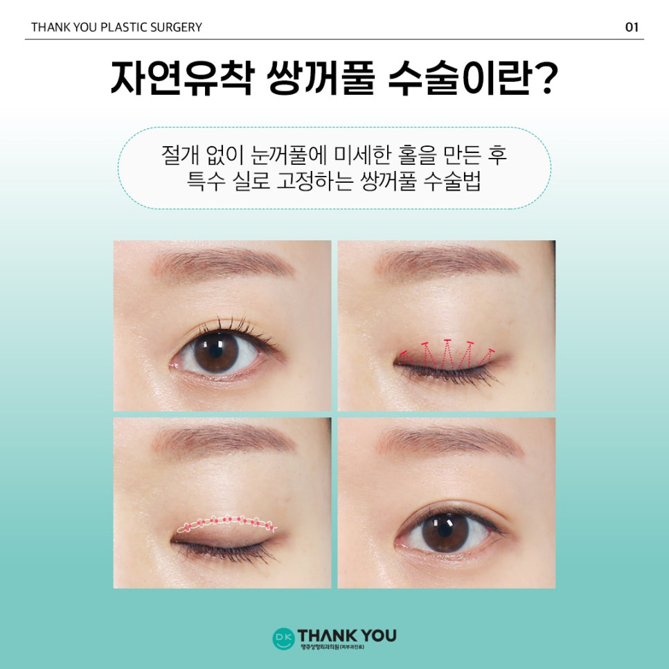 Natural Adhesion Double Eyelid Surgery Done Well: Naturally, as if It Were Meant to Be, at Thank You! image 2