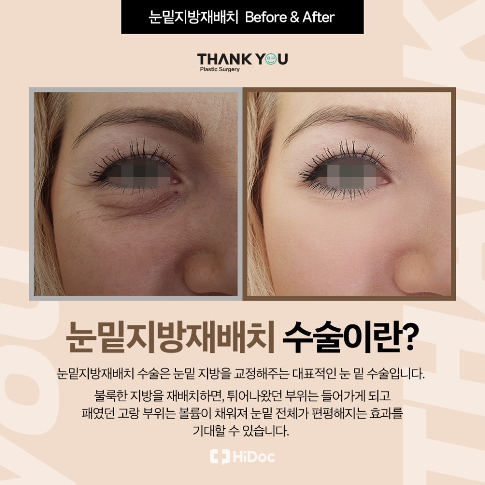 눈밑지 지방이식? 앞광대지방이식 필요한 이유? 관련 이미지 4
