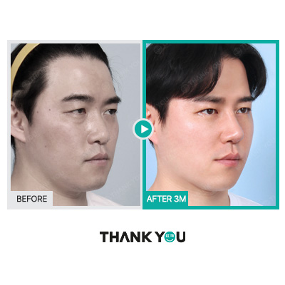 MAKE미남(맥미남) 오덕차장님의 노안 개선&남자 비염코성형 전후 관련 이미지 6