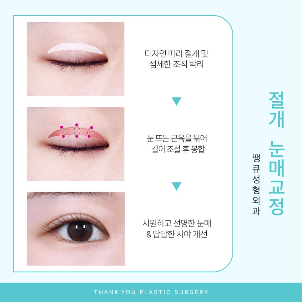 눈매교정잘하는곳 땡큐에서 더 또렷하게, 더 자연스럽게! 관련 이미지 5
