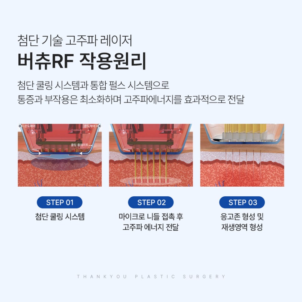 버츄RF 레이저 리프팅✨ 땡큐피부과 EVENT 관련 이미지 4