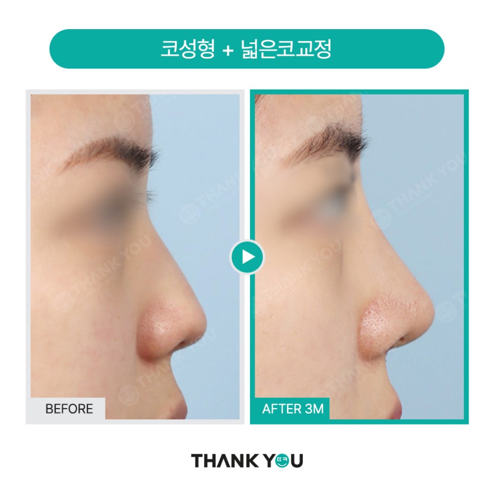 코성형 아직도 L자보형물? 실리콘 선택 기준은? 관련 이미지 6