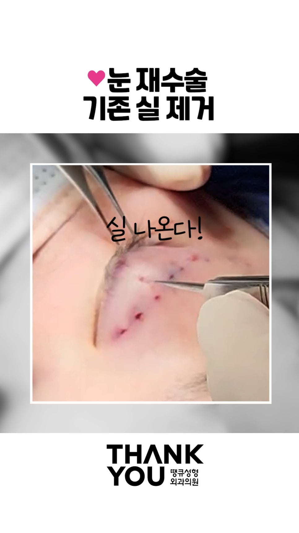매몰 풀기, 매몰 실 제거 (15년 묵은 실)재수술 쌍꺼풀 관련 이미지 3