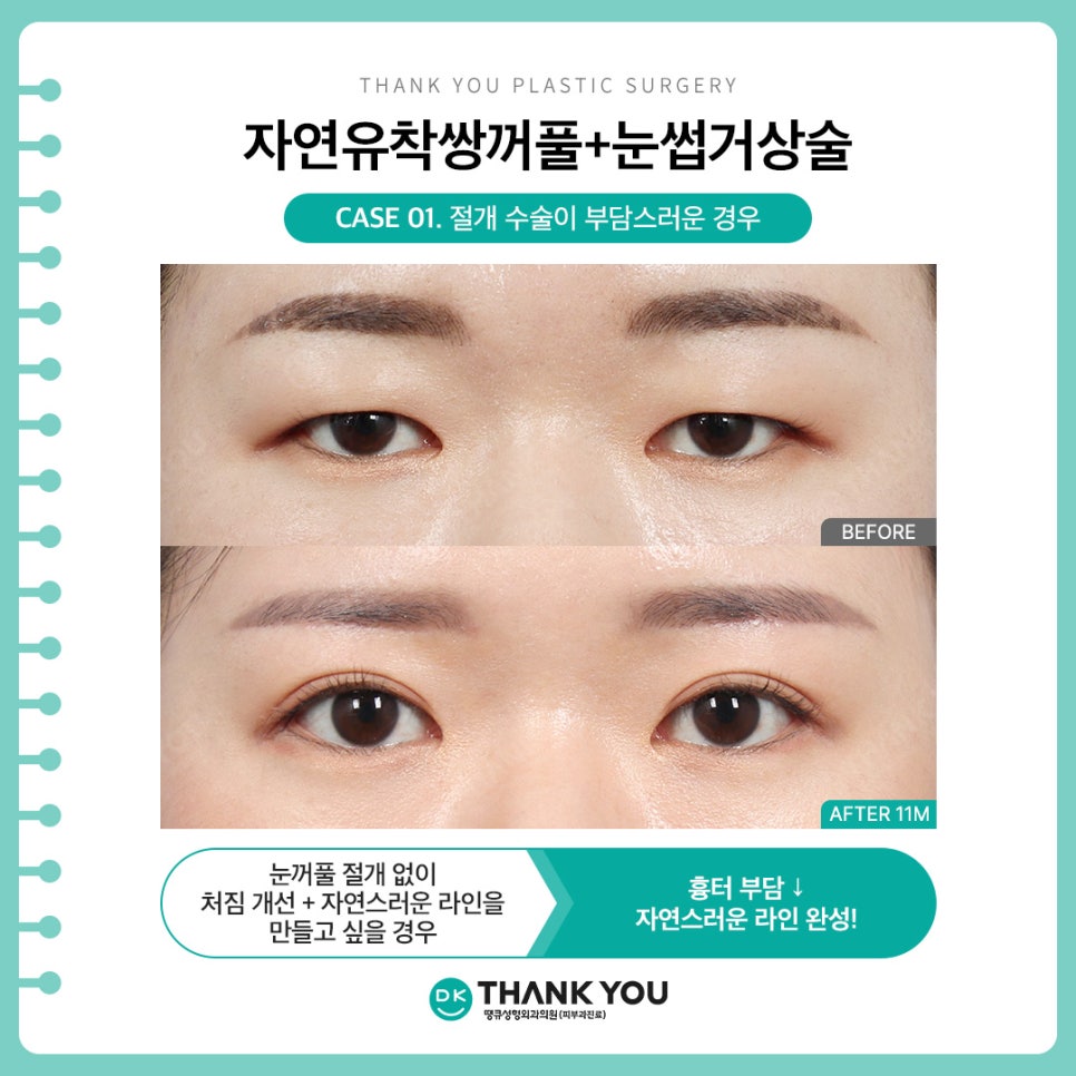 자연유착쌍커풀 + 눈썹하거상술, 자연스러운 라인에 처진 눈 개선까지?! 관련 이미지 4