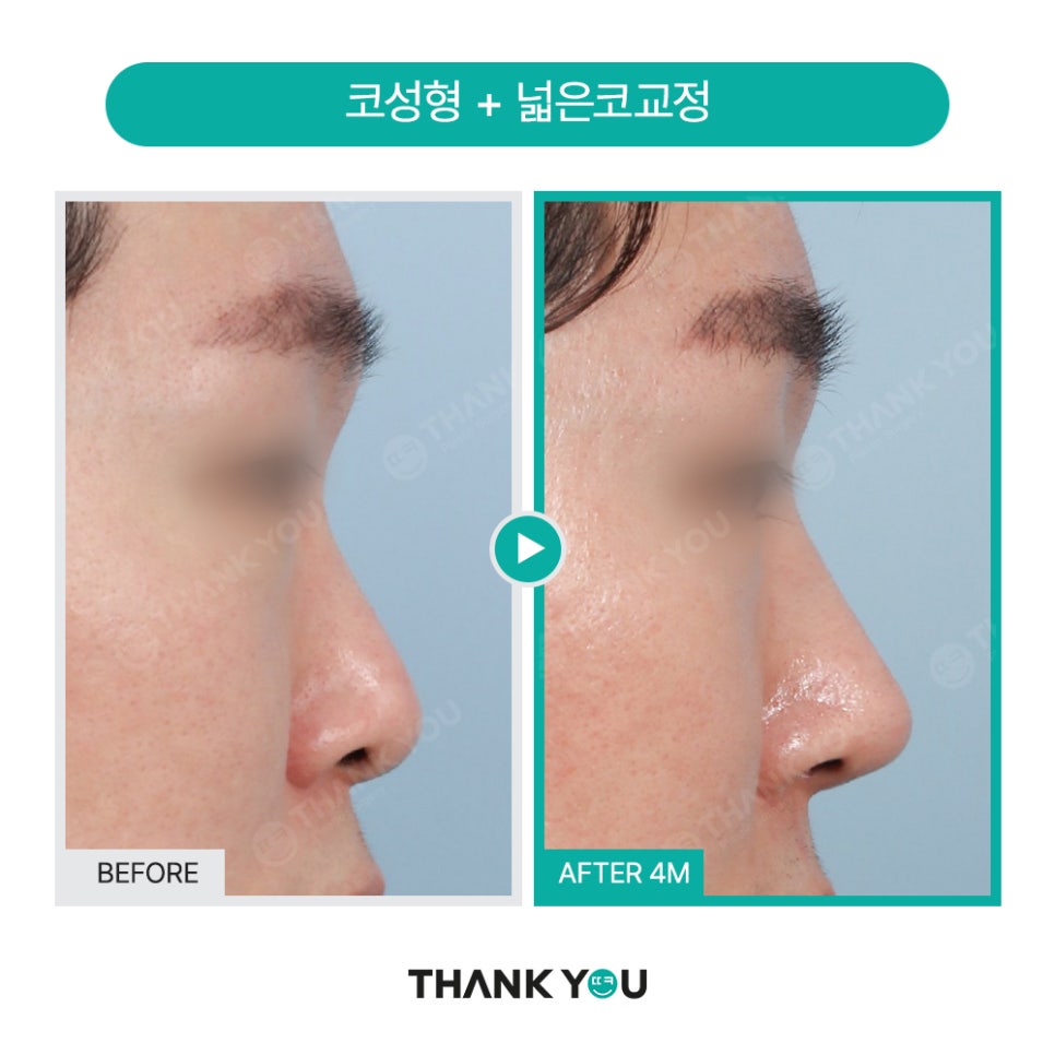 남자코성형 (휜코, 매부리코 등) 기능코성형 필요! [ft.코수술전후] 관련 이미지 9