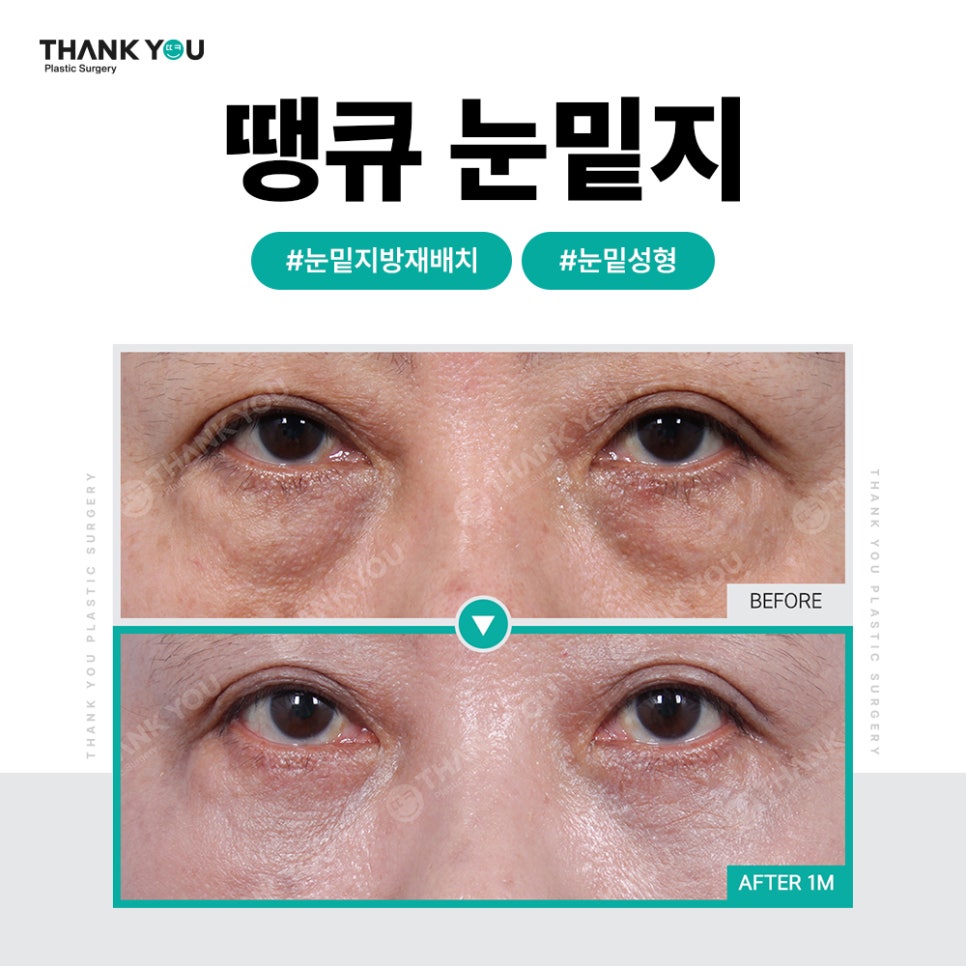 눈밑 불룩, 눈밑지 대신 눈밑지방제거만 단독으로? 관련 이미지 10