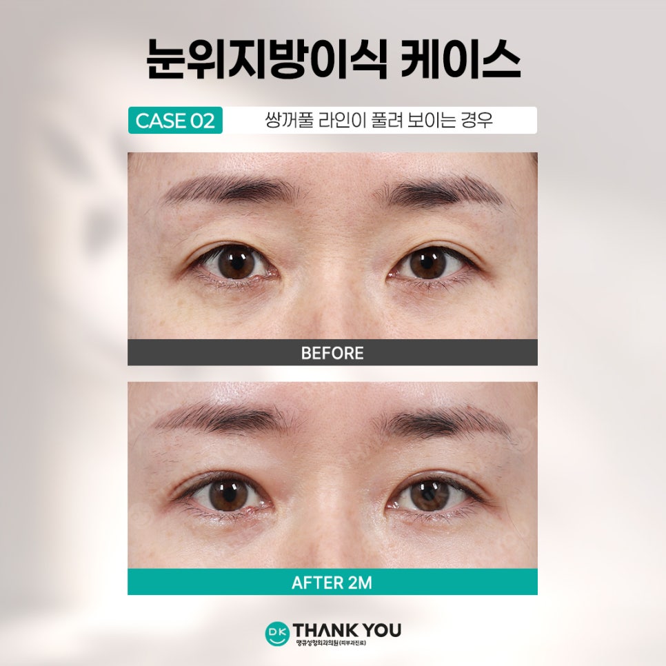 눈꺼풀꺼짐 개선하려면? 꺼진눈지방이식 전에 알아야 할 3가지 관련 이미지 9