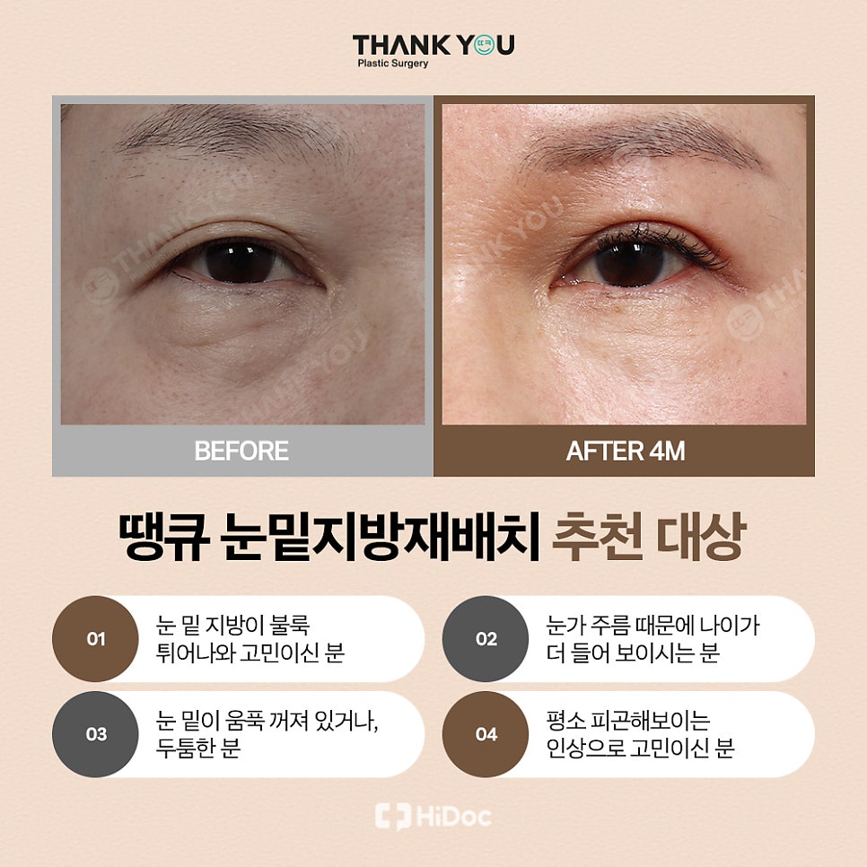 눈밑지 지방이식? 앞광대지방이식 필요한 이유? 관련 이미지 7