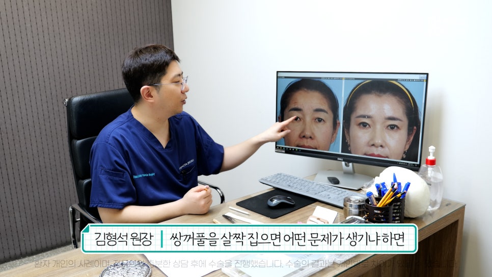 중년눈성형 전후& 이마거상+눈썹하거상+쌍수로 젊어지기 관련 이미지 12