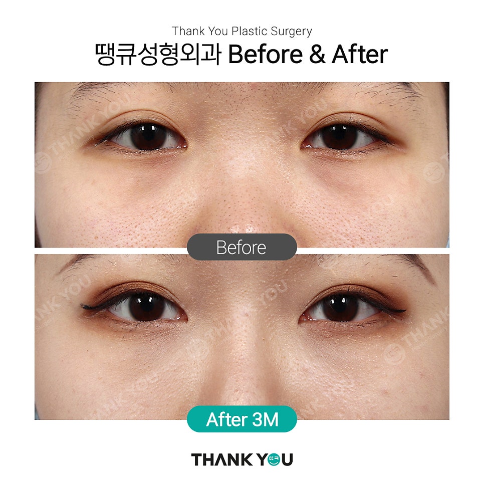 강남 눈밑지방재배치(전후 체크) THANY YOU이벤트 관련 이미지 4