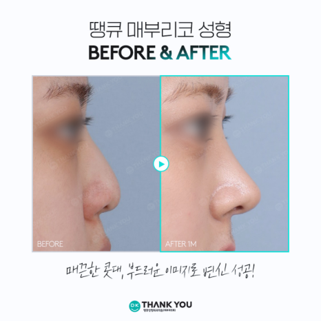 Hump Nose Improvement: Personalized Surgery Is Important! image 8