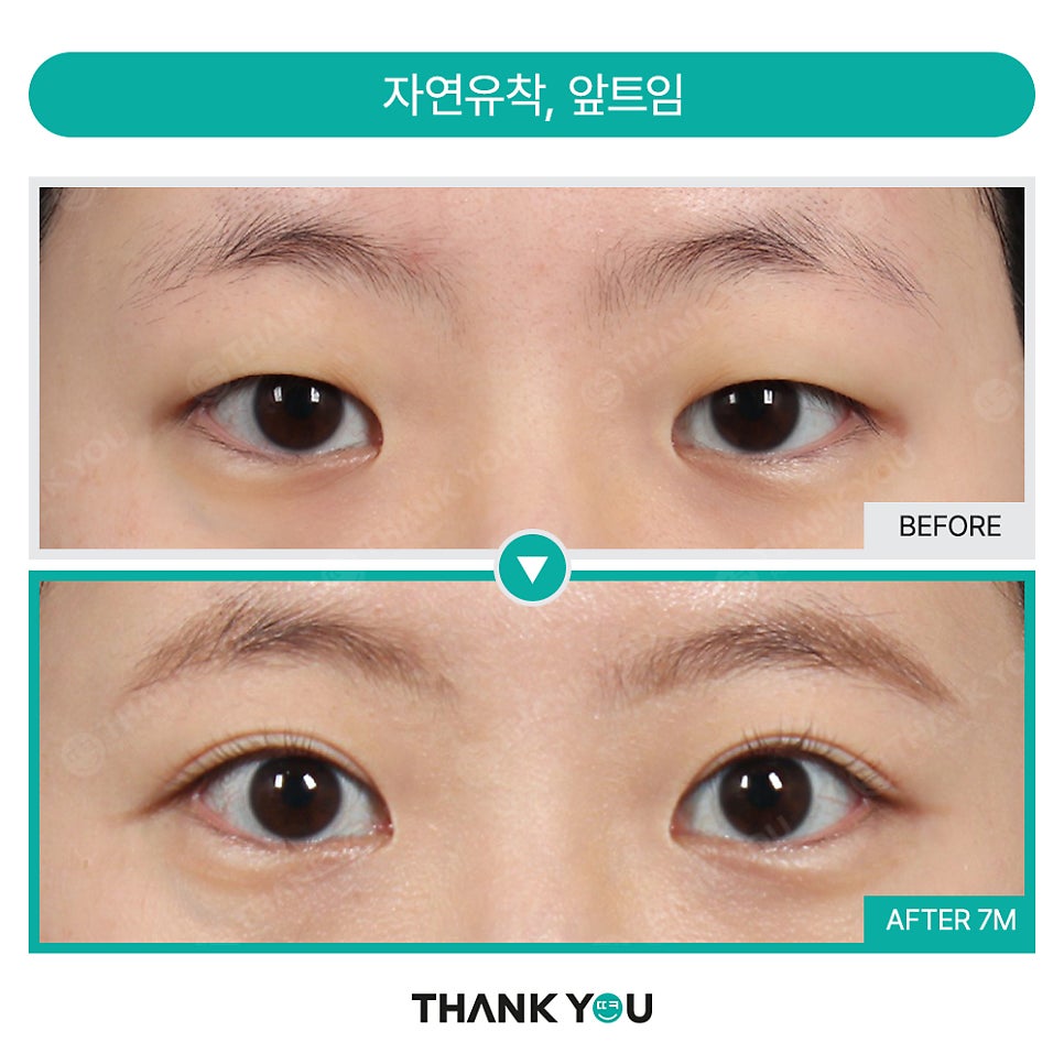 [비절개눈매교정+앞윗트임+눈밑지] 자고 일어났을 뿐인데 제니가?! 관련 이미지 19