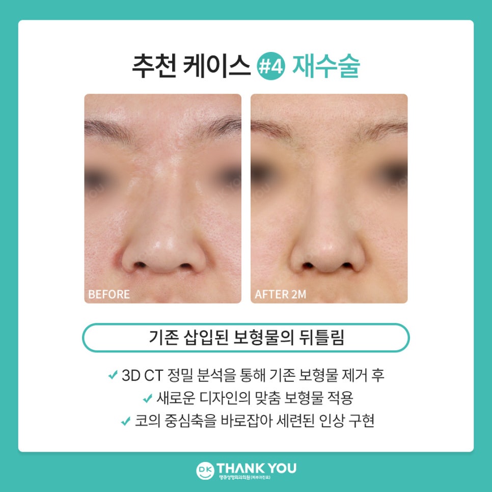 땡큐성형외과 권정우 원장, 코수술재료 관련 이미지 9