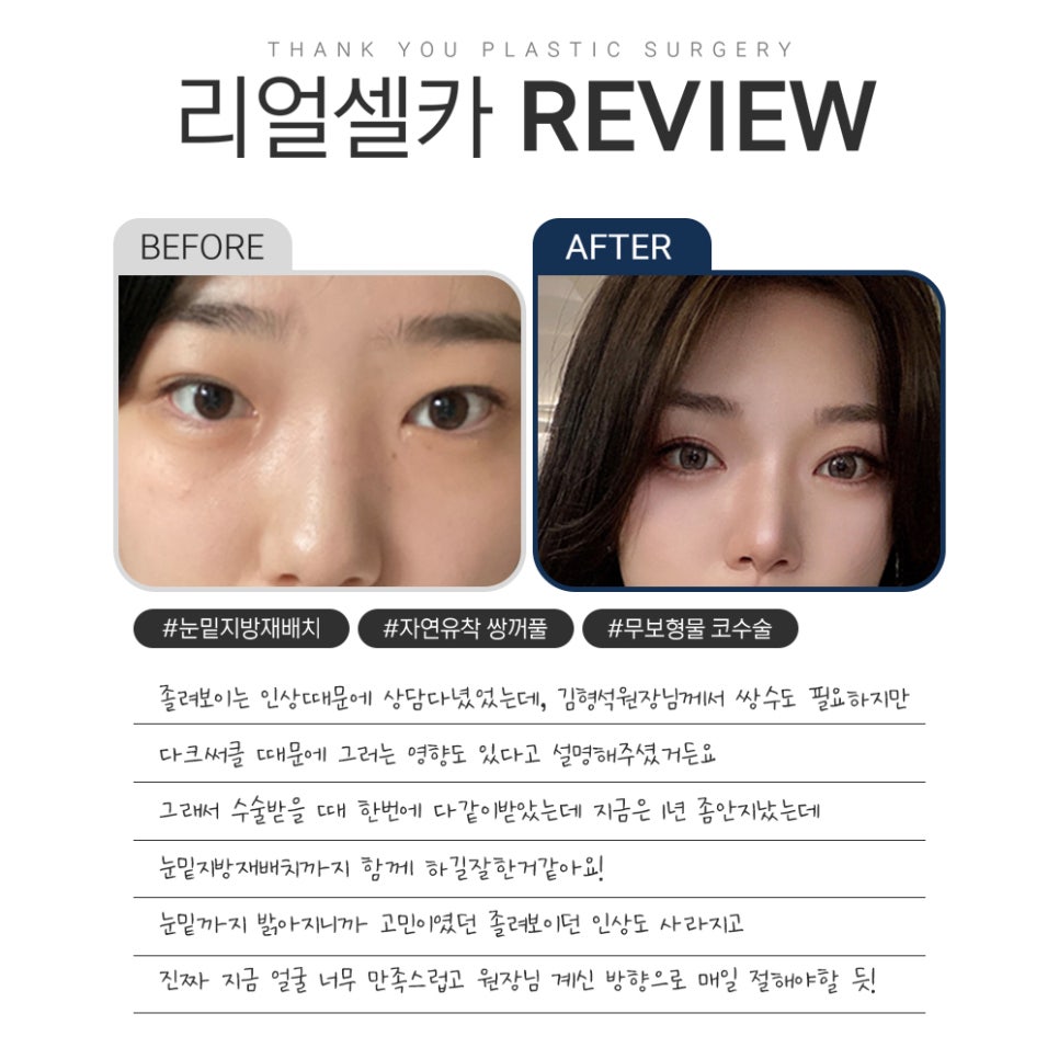 땡큐 다크서클 수술&눈밑지방재배치 리얼셀카  𝐑𝐄𝐕𝐈𝐄𝐖 관련 이미지 2