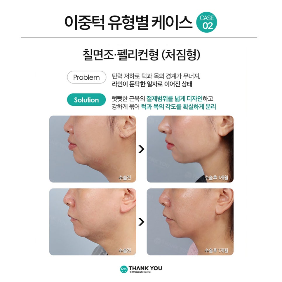 Not Enough Improvement from Chin Liposuction Alone? How About Thank You Double Chin Removal Surgery?! image 7