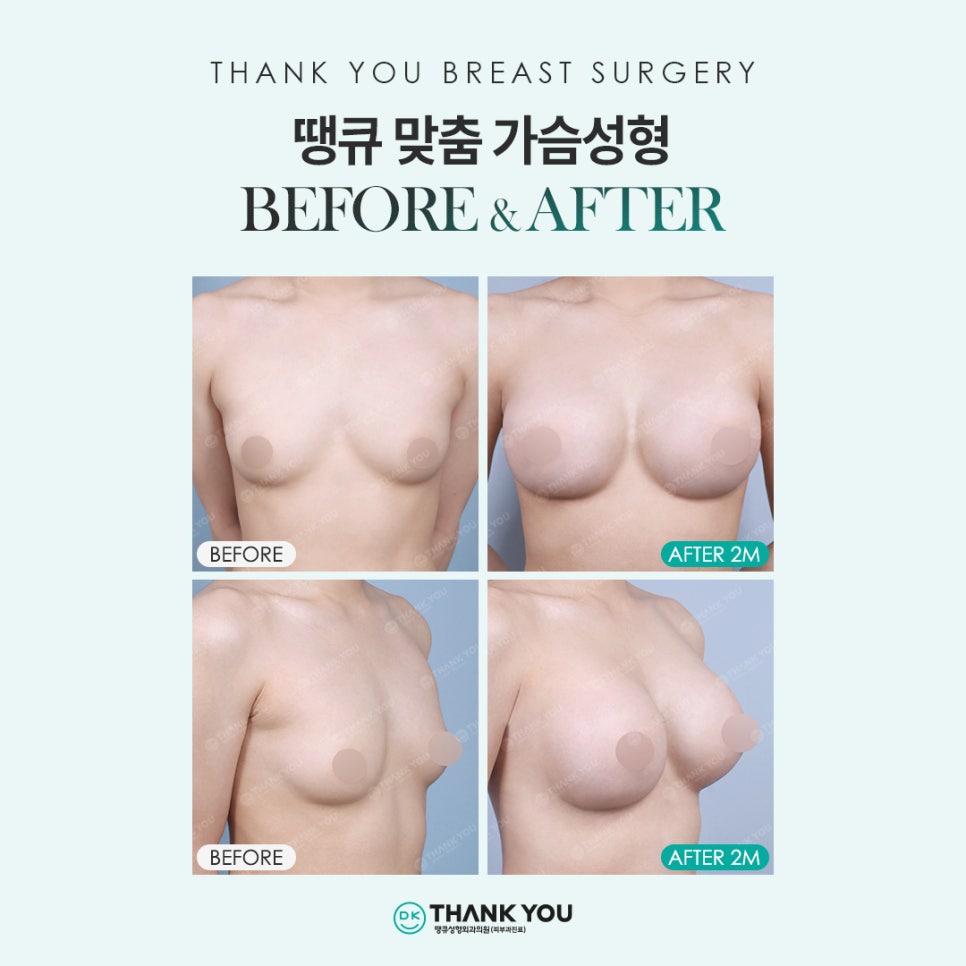 The Importance of Personalized Surgery to Improve Satisfaction Before and After Breast Augmentation! image 13