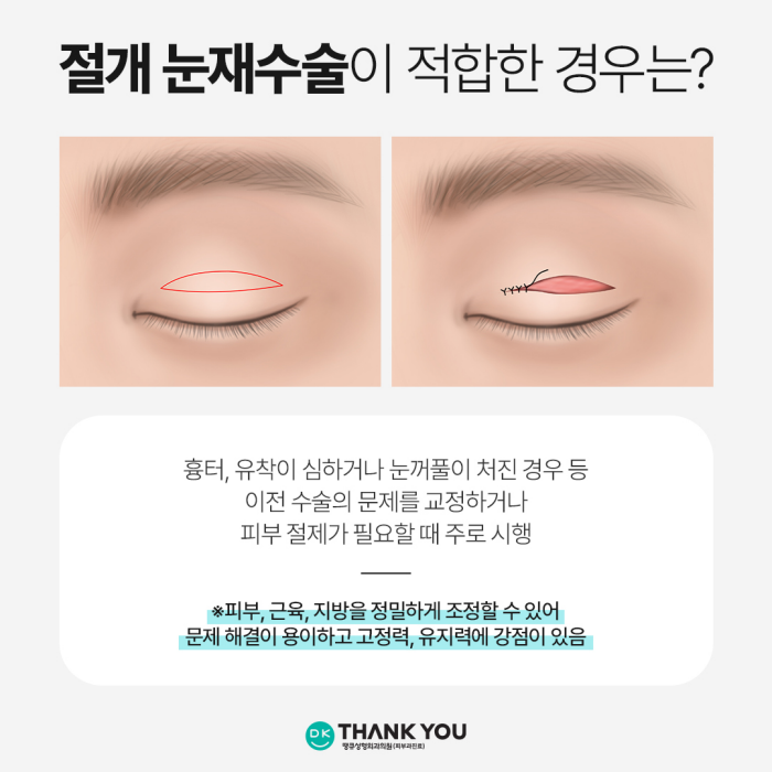 Selection Criteria for Incisional or Non-Incisional Surgery, as Explained by a Specialist in Revision Eyelid Surgery image 3