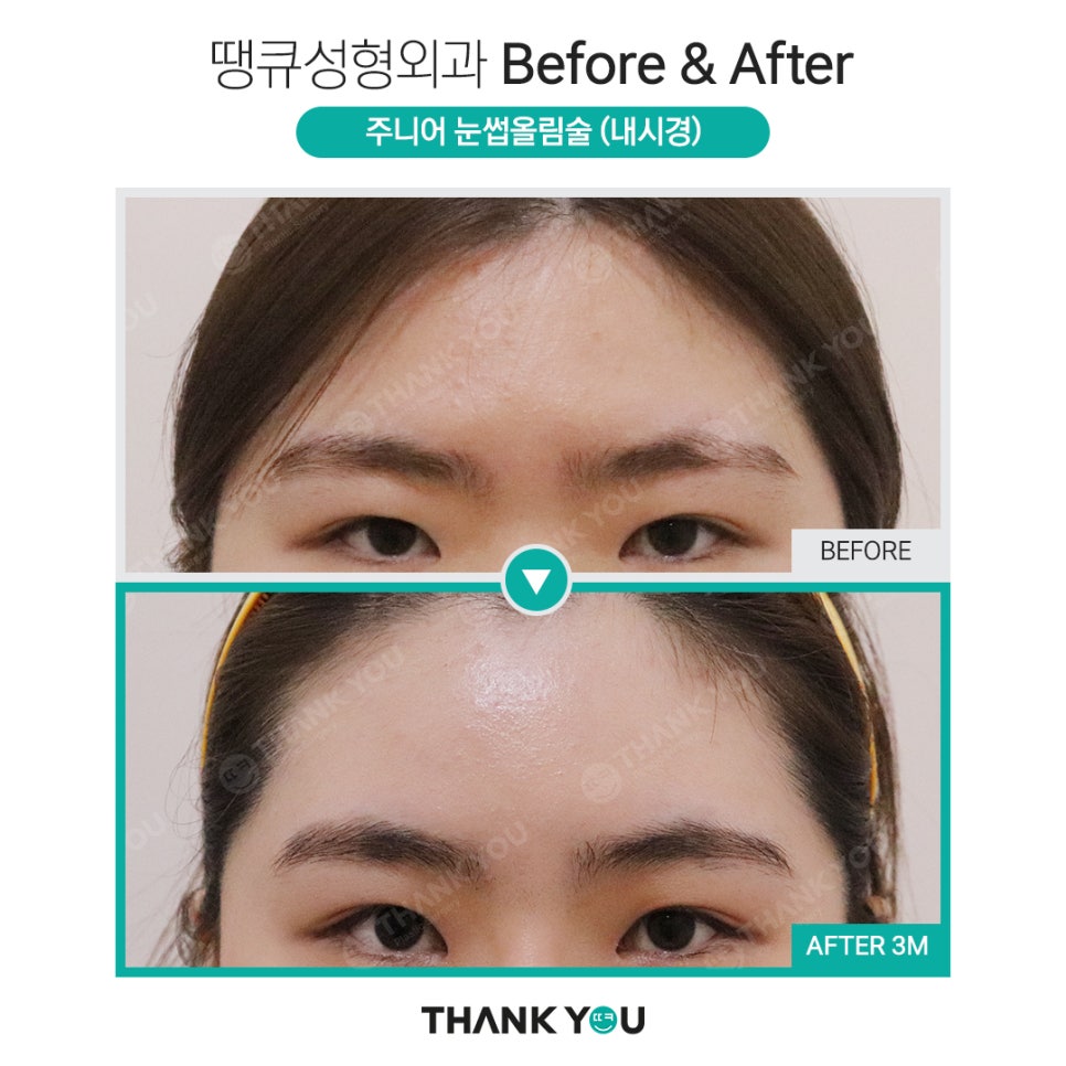 나이가 어린데도 이마거상을 꼭 해야 할까요? 관련 이미지 10