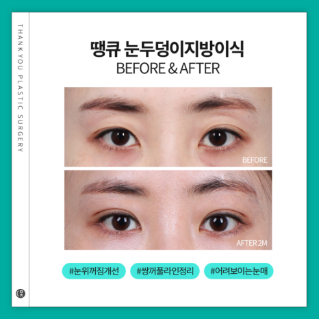 눈두덩이지방이식으로 피곤한 이미지 탈출! 생기있는 눈매 완성! 관련 이미지 8