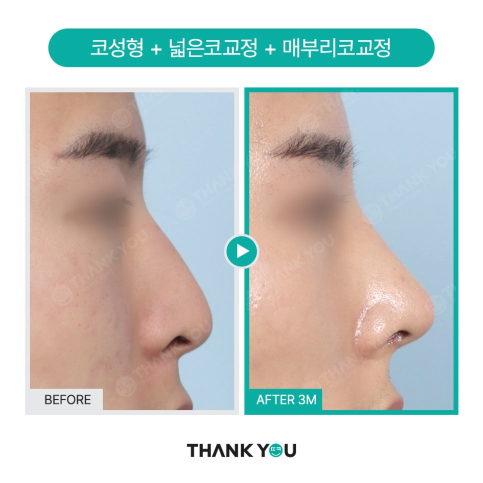 코성형 아직도 L자보형물? 실리콘 선택 기준은? 관련 이미지 9