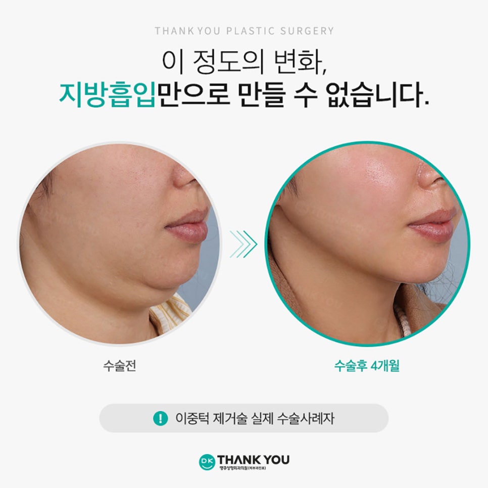 Not Enough Improvement from Chin Liposuction Alone? How About Thank You Double Chin Removal Surgery?! image 2