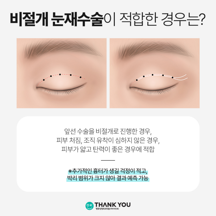 Selection Criteria for Incisional or Non-Incisional Surgery, as Explained by a Specialist in Revision Eyelid Surgery image 4