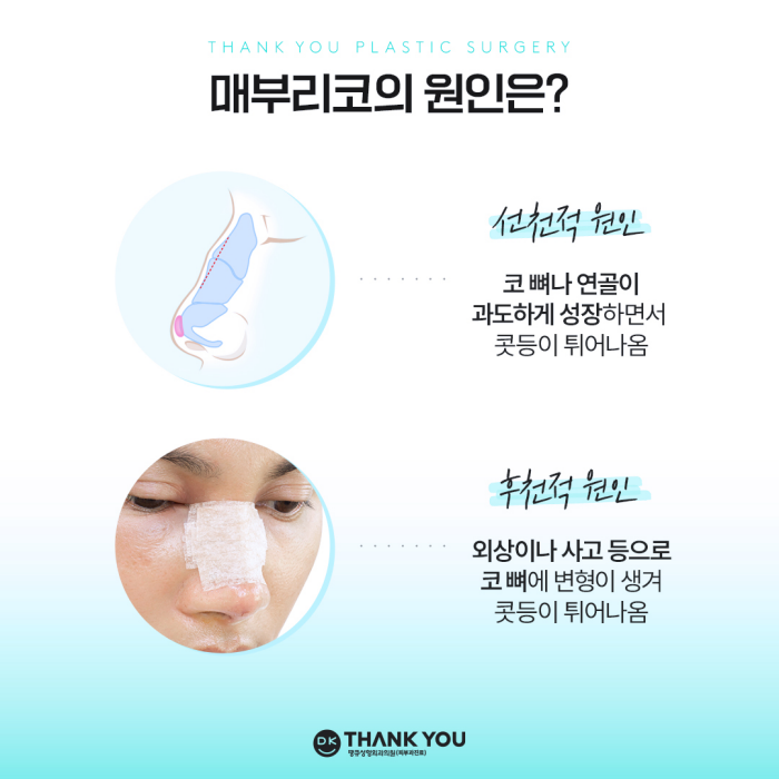 Hump Nose Improvement: Personalized Surgery Is Important! image 3