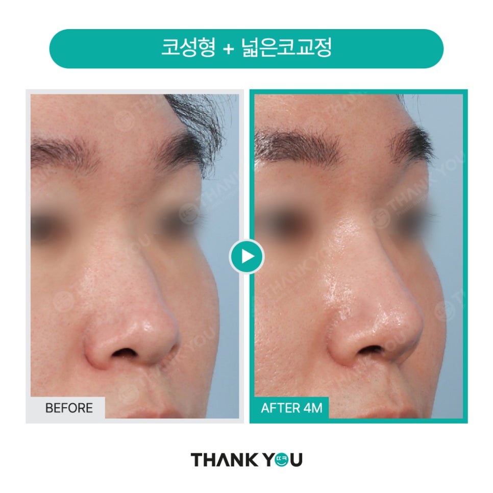 남자코성형 (휜코, 매부리코 등) 기능코성형 필요! [ft.코수술전후] 관련 이미지 7