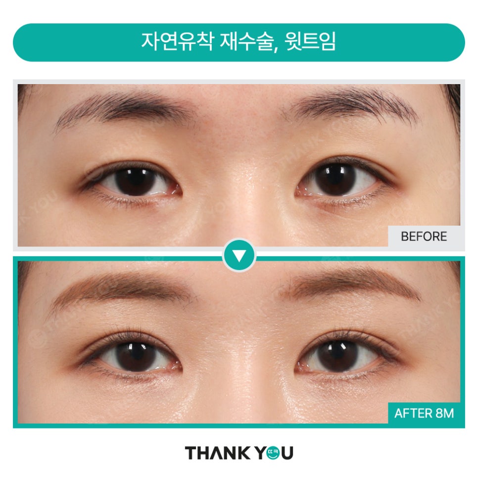 고양이 눈매 완성! (ft.눈매교정+앞,뒤,밑트임+눈밑지) 관련 이미지 19