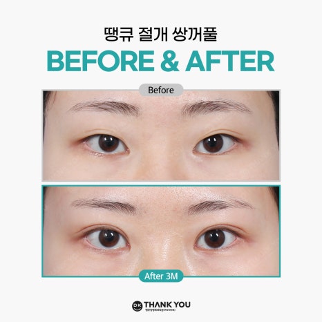 쌍꺼풀잘하는병원 땡큐에서 알려주는 절개vs비절개 수술법의 특징! 관련 이미지 11