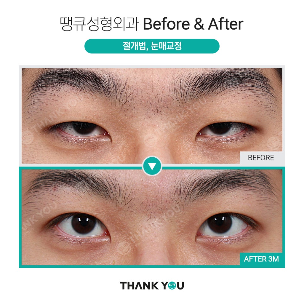 [남자 쌍수후기?] 망하기 싫으면 꼭 보세요! 관련 이미지 20