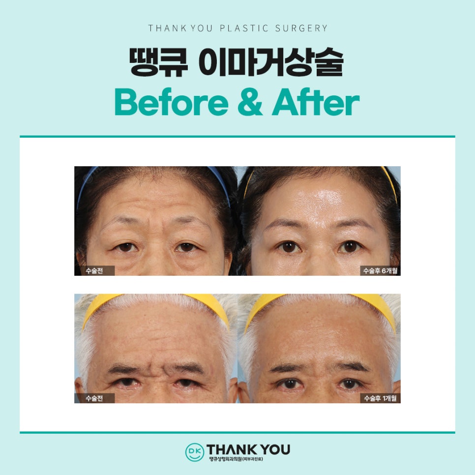 이마거상 흉터, 탈모 걱정된다면? 내시경이마거상술 총정리 관련 이미지 3