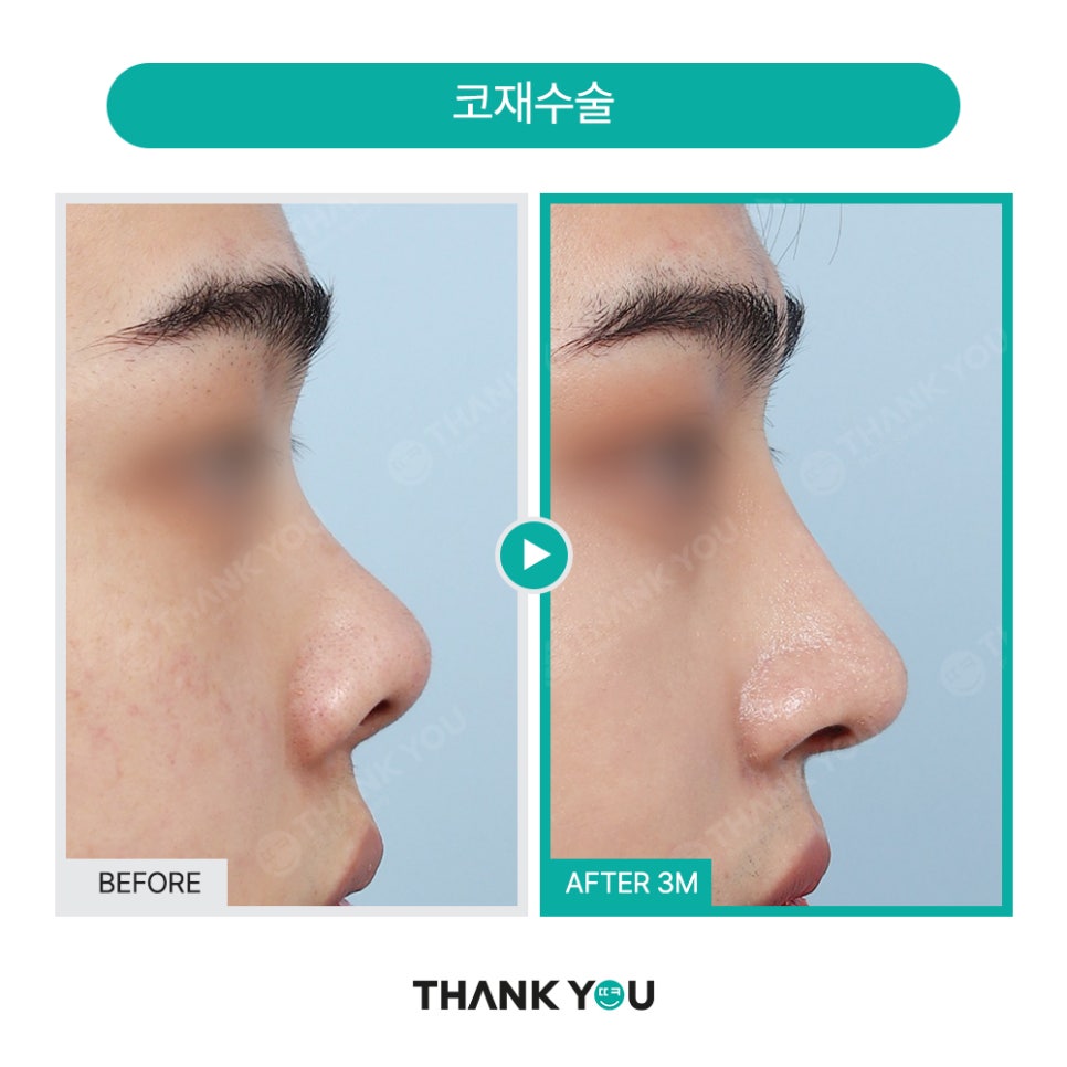 신논현역 성형외과, 남자 휜코성형, 매부리코 성공 포인트는? 관련 이미지 11