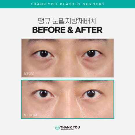 Recommended Under-Eye Fat Repositioning! Transform Your Look to Be Brighter and More Vibrant! image 11