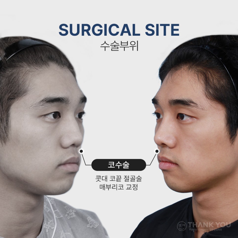 코필러 대신 여자코성형 (콧대+코끝)자연스럽게 관련 이미지 3