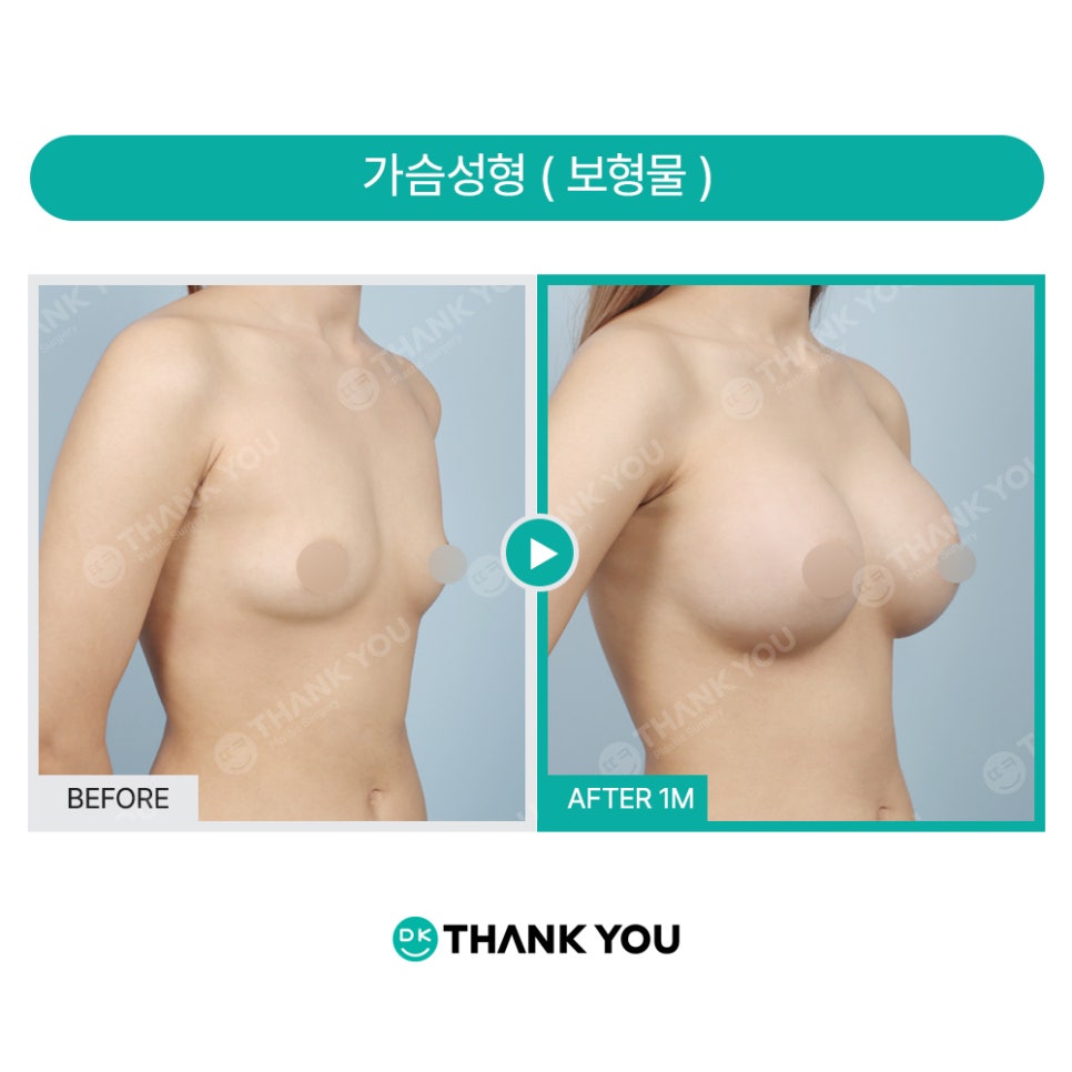 가슴수술주의사항 관련 이미지 6