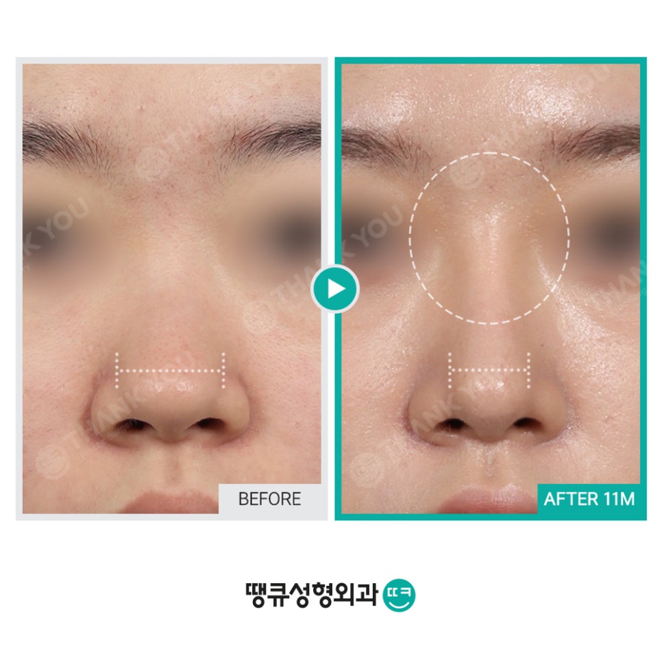 숨이 잘 안쉬어져요 실비코성형 비염도 기능코로 라인 커버! 관련 이미지 4