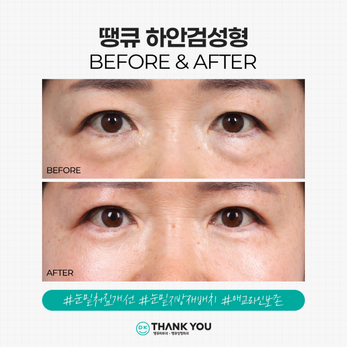 Solving Under-Eye Aging with Lower Blepharoplasty! image 9